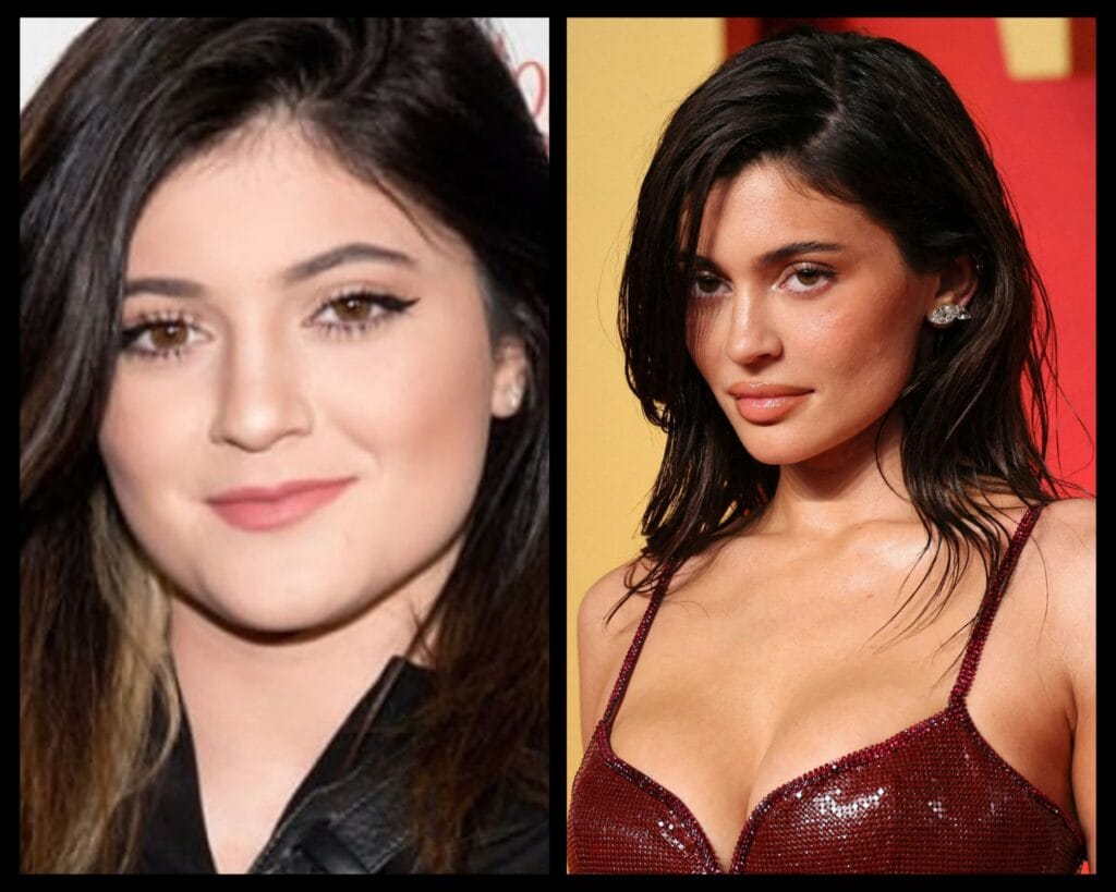 Kylie Jenner Face Shape: Before and After Surgery, Transformation Explained 1 incollage 20260128 0029119063835761632686157537